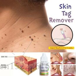 Skin Tag Remover 12 hours Tu kill Medical Tu kill Remover Skin Tag Mole